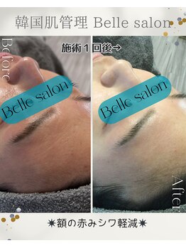 ベルサロン(Belle salon)/敏感肌によるトラブル軽減