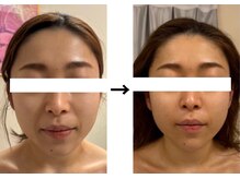 ドクターエイジレス(DR.AGELESS)/バイオセルショットコース1回