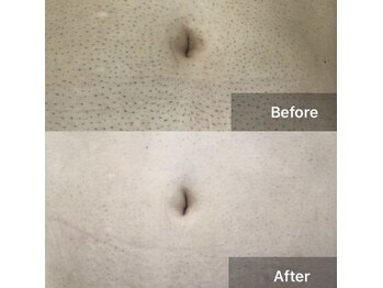 サロン シェリミー(Cheri mi)/男性美肌脱毛Sパーツへそ周り