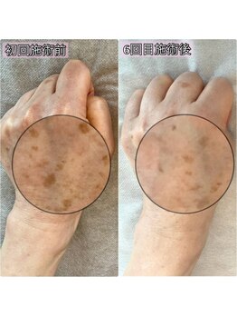 ソレイユ(Soleil)/手の甲年齢にも対応可能