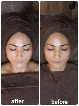 ウララ(ulala)/ララ1回のビフォアフ