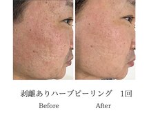 メンズミーシェ(Men's Meshie)/リベルハーブピーリング施術前後