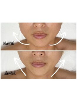 キーオブフェイス(Key of Face)/お悩み【顔が大きく見える】