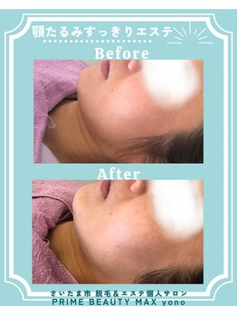 マックス 与野店(MAX)/【顎周りのたるみ】も1回で？！