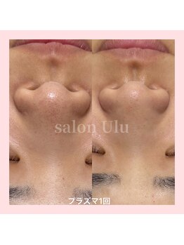 ウル(Ulu)/初期の毛穴改善