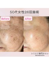 モモイロ(momoiro)/シミケア45分/肌診断でビックリ!