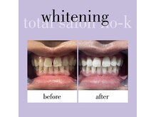 お肌・眉毛・歯を綺麗にしたいならNO-Kへ♪(脱毛・眉毛)