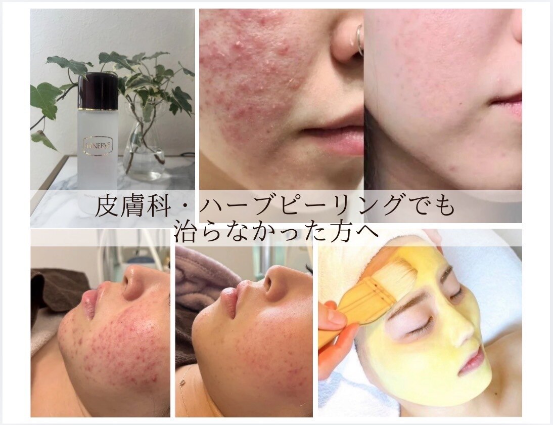 福岡県で毛穴ケアが人気のエステサロン｜ホットペッパービューティー
