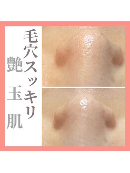 トータルビューティーサロン ヴィヴィエ(ViVier)/スッキリ毛穴ケア