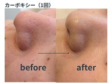 ミジタク 京都二条店(mijitaku)/カーボキシー1回のお肌