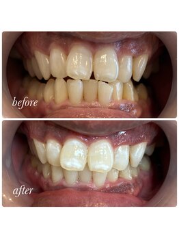 ティースホワイトニング 沖縄うるま市(Teeth Whitning)/ビフォーアフター 20代 女性