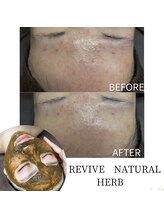 イル 名取店(iru)/剥離なし！国産ハーブピーリング