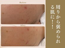 ベラノーブル(bella noble)/鼻周りの毛穴に黒ずみやザラつき