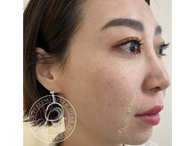 ハーバリー ハーブピーリング 岐阜(HERBERRYハーブピーリング)/最強ハーブピーリング【リベル】