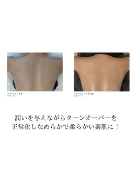 ルーチェエムベルシック(Luce.MBelChic)/背中ニキビケアも人気です