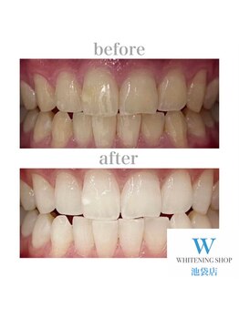 ホワイトニングショップ 池袋店/【ビフォーアフター】美白
