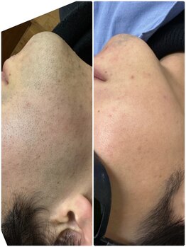 リリーサロン 松本平田店(LILYSalon)/リリーサロンはお顔全体脱毛◎