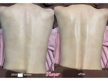 フルール(Fleur)/■背中トリートメント■