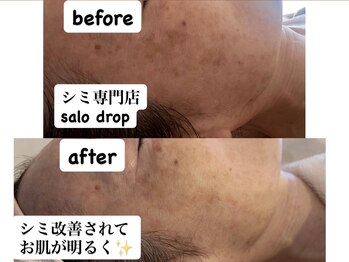 サロン ドロップ 上小田井(Salon drop)/「シミ改善」