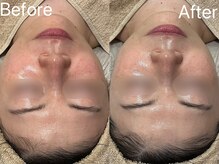 シェリーミル(Cherie Miru)/ダウンタイムの赤み軽減