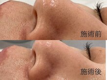 ハイドラで毛穴洗浄！古い角質取れる＆肌はワントーンup＆艶肌！