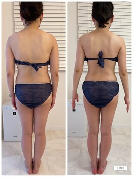 メロウプラス 錦糸町店/内腿のセルライトケア