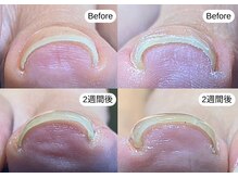 トレデュール 長町南店(Tre's dur)/巻き爪ケア　