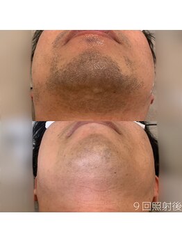 WA ネイル アンド ビューティー(WA nail & beauty)/ヒゲ脱毛