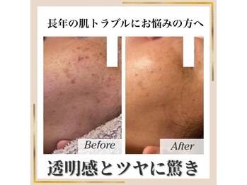 ココ(KOKO)/長年のハダトラブル諦めないで
