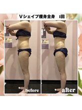 ルピナス ヒサヤ(LUPINUS hisaya)/Vシェイプ痩身　全身