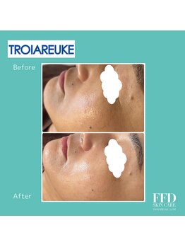 エフエフディースキンケア(FFD SKINCARE)/ピーリング症例