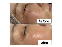 ランソ ビューティー 成田(RUNSO Beauty)/シミケアマシン【リアージュ】