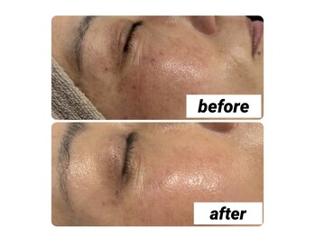 ランソ ビューティー 成田(RUNSO Beauty)/シミケアマシン【リアージュ】