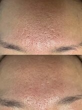 シレーヌ(Sirene)/黒ずみ毛穴集中ケア★ピーリング