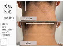 サロン ド パーフェクション(Salon de Perfection)/脱毛