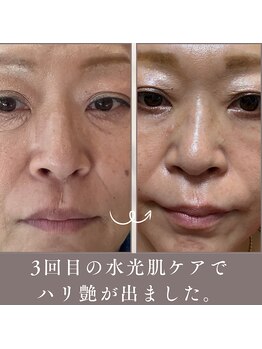 エステリワール|韓国肌管理・韓国育毛促進ケア・小顔・毛穴・脱毛・シワたるみの写真/PLLAポリ乳酸でハリ弾力潤い艶を叶える!小じわケアで輝く素肌へ導く特別な体験を☆