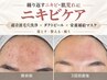 【繰り返すニキビ・肌荒れに】肌質改善ダクトピール＋栄養補給