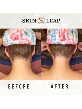 スキンリープワックスサロン 川崎店(SKINLEAP Wax salon)/うなじ脱毛