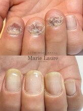 マリーロール 梅田店(Marie Laure)/自爪育成/深爪矯正/ネイルケア