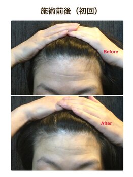 ミクロスポーツ整骨院(MICRO SPORTS整骨院)/【befor/after】40代〔シワ〕