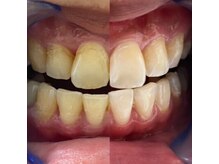 ホワイトニングショップ 長岡京店/【ビフォーアフター】美白