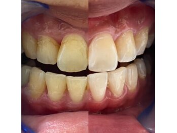 ホワイトニングショップ 長岡京店/【ビフォーアフター】美白