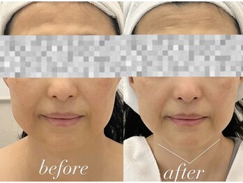 ミランサ ギンザ(MIRANSA GINZA)/コンフォート＋フェイスビート