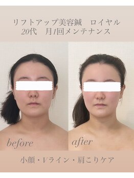 めい鍼灸院/リフトアップ美容鍼 ロイヤル