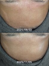 ビジュープラス 倉敷店(Bijou+)/【毛穴ケア】ハーブピーリング