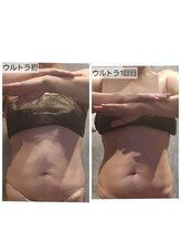 ヴィトワ(Vitowa)/ウルトランスフォーマー施術例4