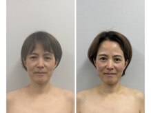 トゥルーカラーズの雰囲気（美容鍼で小顔、リフトアップ）