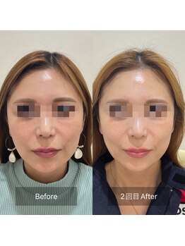 ラ クレール ビューティーサロン(LA CLAIR)/小顔リフトマシン豊富に取り揃え