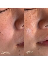 シュカ(Shuka)/ハーブピーリング