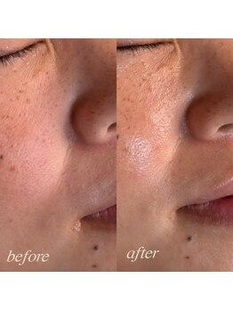 シュカ(Shuka)/ハーブピーリング